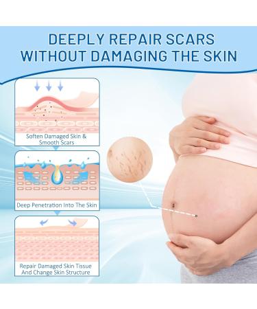 Best Stretch Mark Removal Cream - Pregnancy & Scar Treatment | Deep Repair Belly Butter 2.82 Oz - Buy Online on GoSupps.com