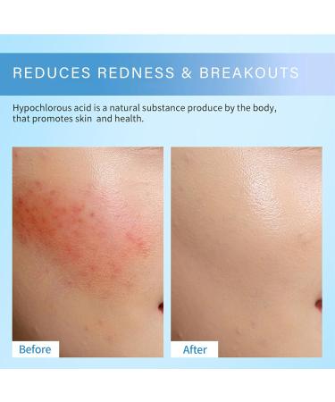 Hypochlorous Acid Spray for Face and Body 2.2 Fl Oz Hypochlorous Acid Spray for Face Reduce Redness & Breakouts Face Spray Safe for Acne Prone Skin 100% Natural Alcohol Free Oil Free - Buy Online on GoSupps.com