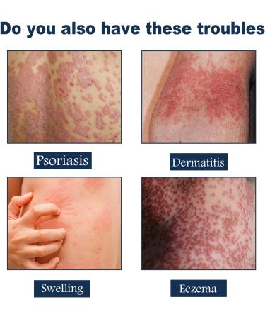 TGMALL 2023 Psoriasis Treatment Spray & Soothing Ointment - Skin Cleansing Relief (3pcs) - Buy Online on GoSupps.com