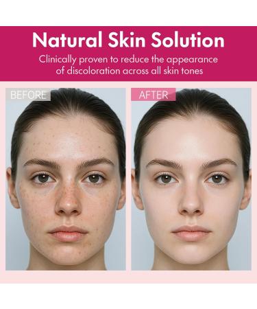 Roseblem Arbutin 7% + Tranexamic Acid 4% Face Cream for Dark Spots & Uneven Skin Tone Hydrating Non-Irritating Safe for Sensitive Skin 1.76 oz (Pack of 1) - Buy Online on GoSupps.com