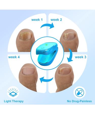 iKeener Nail Fungus Laser Treatment Device - Home Use Pain-Free Fungi Nail Remover for Fingernails & Toenails - Clean, Repair, and Cure Nail Fungus in Just 7 Minutes a Day - Don't Be Embarrassed Again! (Blue) - Buy Online on GoSupps.com