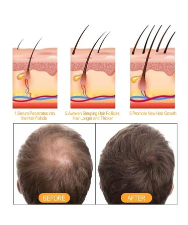 Ginaday Instant Ginger Hair Regrowth Shampoo 17.6oz - Promotes Hair Growth, Prevents Hair Loss - Ginger Hair Care Shampoo - 1pcs - Buy Online on GoSupps.com