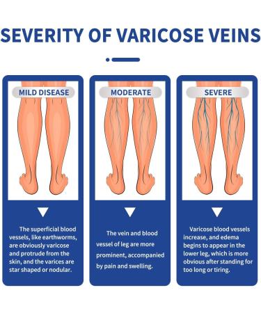 Varicose Veins Cream - Treatment for Leg Spider Vein Relief and Healing - Buy Online on GoSupps.com