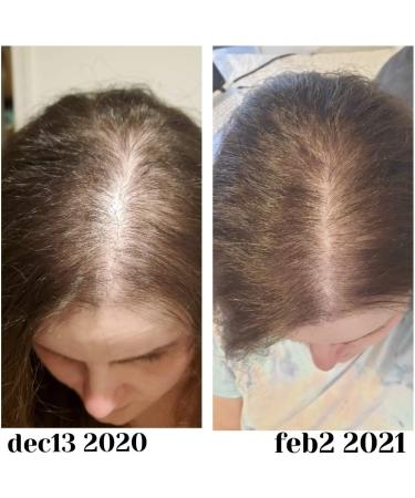 Baby Blues Postpartum Hair Loss Vitamins - Biotin, Collagen, Folate Gummies 60ct - Passion Fruit Flavor - Buy Online on GoSupps.com