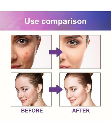 144Pcs Acne Stickers for Home, Irregular Shape Pimple Elimination - Acne Patches - Buy Online on GoSupps.com