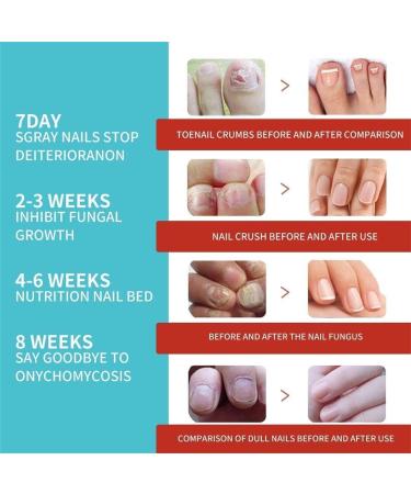 2024 New 3Boxes/48pcs Anti Fungus Nail Treatment Patches Toe Fungus Onychomycosis Repair Sticker Nail Patches - Buy Online on GoSupps.com