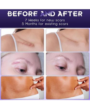 Silicone Scar Gel for Surgical Scars, Stretch Marks, Acne & Keloids - Scar Removal Cream Gel for New Scars - Buy Online on GoSupps.com