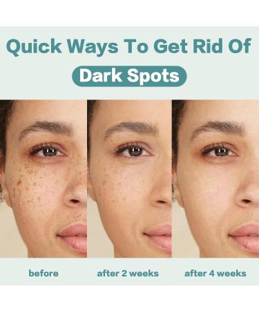 Dark Spot Remover for Face Dark Spot Corrector Cream Hyperpigmentation Melasma Freckle Sun Spots Removal for All Skin Types Dark Spot Corrector for Men and Women-1.7 fl oz - Buy Online on GoSupps.com