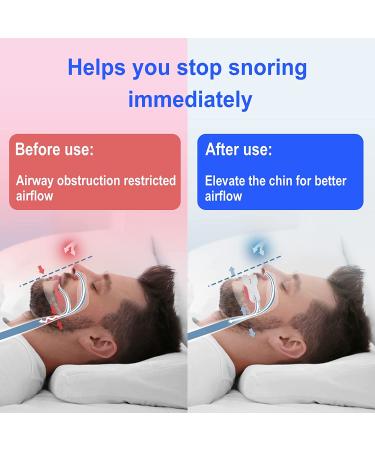 Anti Snoring Mouthpiece - Comfortable & Adjustable Snoring Solution - Buy Online on GoSupps.com