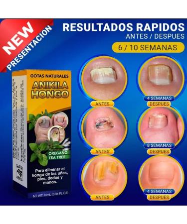 Buy Organic Tea Tree Foot & Nail Fungus Cream - 0.34 fl oz | International Shipping Available - Buy Online on GoSupps.com