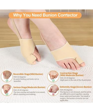 Bunion Corrector for Women & Men | Big Toe Straightener & Orthopedic Splint for Hallux Valgus | Comfortable & Breathable Day/Night Support - Buy Online on GoSupps.com