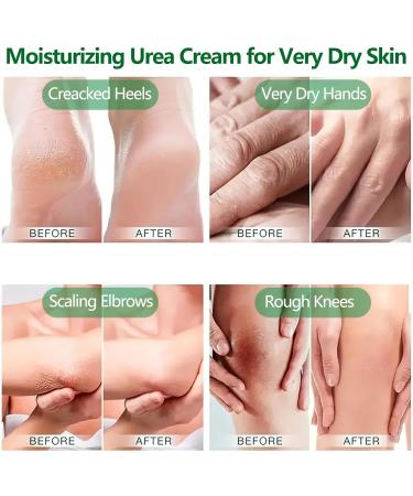 40% Urea Foot Cream - Moisturizing Urea Cream for Very Dry Feet - Cracked Heel Repair Cream for Foot Care - Heel Cream for Deep Cracked Skin - Feet Cream for Calluses and Hard Skin - Buy Online on GoSupps.com
