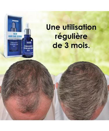 Luis Bien Blue Hair Growth Serum Kit | Hair Loss Treatment for Men & Women | Thickening Oil with Derma Roller | 30 ml Regrowth Solution - Buy Online on GoSupps.com