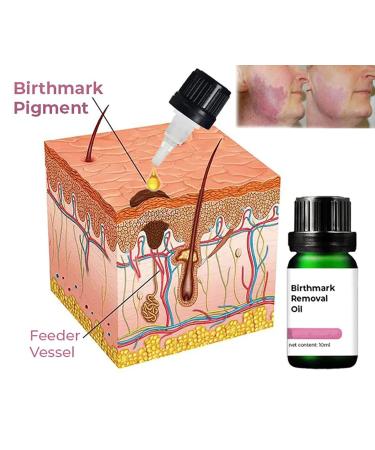 GFOUK German Birthmark Removal Oil & Cream - Dark Spot Remover for Face Acanthosis Nigricans Therapy Oil (2PCs) - Buy Online on GoSupps.com