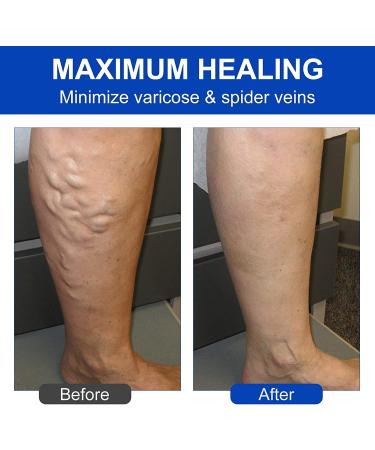 EFINITYER Varicose Veins Treatment Patch - Promotes Metabolism, Improves Blood Circulation, Relieves Heavy Tired Legs - Yellow (12 Pcs) - Buy Online on GoSupps.com