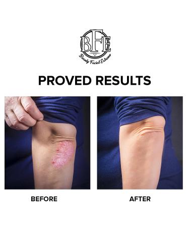 Keratosis Pilaris Exfoliating Body Lotion - 12% Lactic Acid for Smooth Skin | Immediate Moisture & Gentle Exfoliation - Buy Online on GoSupps.com