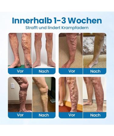  Davivian Varicose Vein Reducing Spray Varicose Vein Spray for Legs 30ml Soothing Solution for Calf Swelling for Women and Men's Legs - Buy Online on GoSupps.com