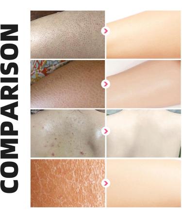 Body Exfoliator Moisturiser for Arms & Leg Skin Exfoliating Repair Cream Chicken Skin Care Cream Body Cream for Strawberry Legs Treatment - Buy Online on GoSupps.com