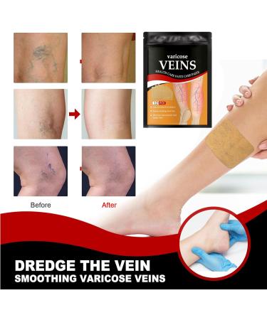 Varicose Vein Relief Patches - Herbal Plasters for Spider Veins & Leg Treatment | International Shipping - Buy Online on GoSupps.com