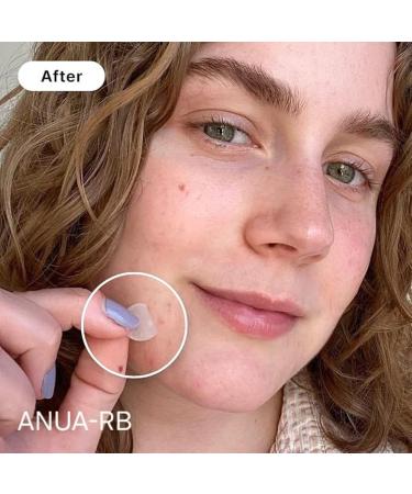 Buy Acne Pimple Patch - 240 Hydrocolloid Stickers for Face & Body | Original 3 Sizes Non-Toxic Cruelty-Free - Buy Online on GoSupps.com