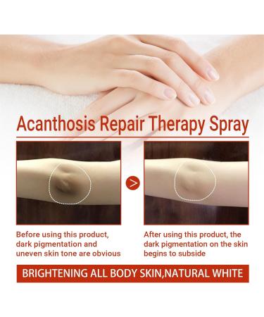 Acantho Clear Therapy Spray - Acanthosis Nigricans Treatment (1 pcs) - Buy Online on GoSupps.com
