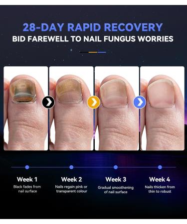 IUHFSIFS 2024 Upgrade Nail Fungus Laser Treatment Industry No.1 Laser Treatment - SGS Certified 21-day Fast-acting Fungal Nail Treatment for Toenail Fungus Red Light Infrared Blue Light(NEW) 01-Ivory - Buy Online on GoSupps.com