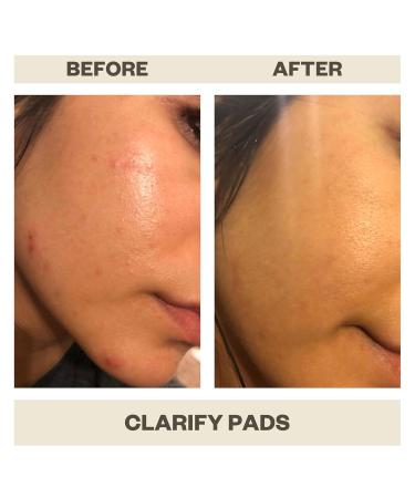 AziMD Skincare Clarify Pads for Face & Body Acne | 2% Salicylic & Glycolic Acid - International Shipping Available - Buy Online on GoSupps.com