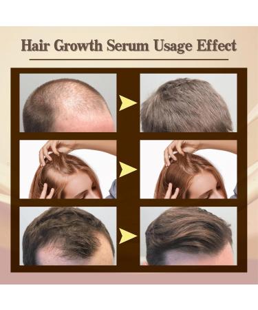 Trendyfave Hair Growth Serum Hair Serum for Hair Growth Ginger Hair Growth Serum Anti Hair Loss Essence for Fast Hair Growth Nourishing Repair Damaged Hair Stimulates Hair Growth Serum for Women Men - Buy Online on GoSupps.com