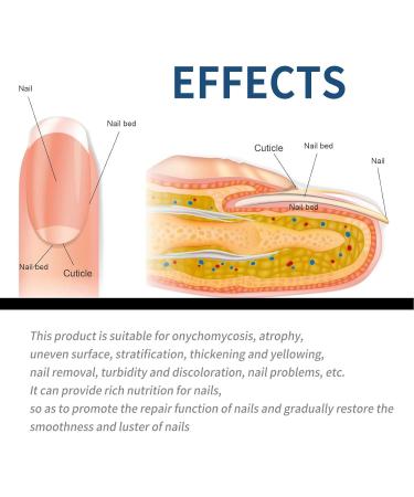 32 Pieces Toe Nail Repair Patch Soft Nail Inlay Gray Nail Care Toe Nail Thickening Clear Nail Groove Repair Patch - Buy Online on GoSupps.com