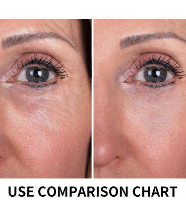 HYPOD Pdo Threads Lift for Eyes - 20PCS, 30G*25MM - Reduce Wrinkles & Sagging - Eye Area PDO Lifting Thread - Buy Online on GoSupps.com