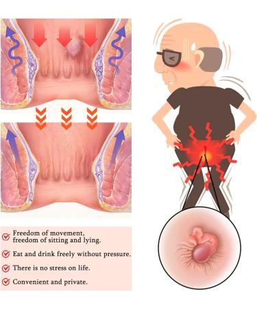 2 Pcs Hemorrhoid Cream Hemorrhoid Cream Body Creams Soothing Itching Burning Symptom Treatment Ointment Herbal Soothing Itching Ointment - Buy Online on GoSupps.com