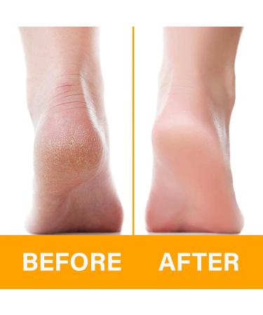 Feeties Foot Rasp File Hard Skin Remover Pedicure Stainless Steel Professional Metal File Scraper - Buy Online on GoSupps.com