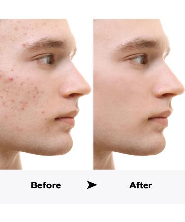 LED Acne Foe: Red & Blue Light Therapy Device for Effective Acne Spot Treatment - Facial Aesthetic Solution - Buy Online on GoSupps.com