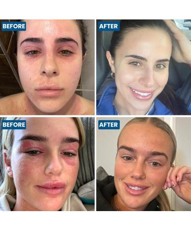 Grahams Natural Face & Body Eczema Cream Set - C+ Eczema Lotion (1.76oz) + Face & Eyelid Cream (1.76 oz) - Buy Online on GoSupps.com