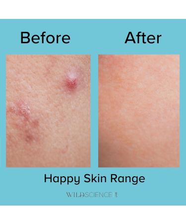 Wild Scicen Lab HAPPY BALANCE AHA + BHA + Zinc Clarifying Essence | Acne-Prone Skin Solution - International Shipping Available - Buy Online on GoSupps.com
