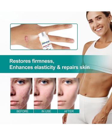 Medical Grade Advanced Scar Remover Spray - Treat Acne, Surgical Scars & Stretch Marks - 3x20ml - Buy Online on GoSupps.com