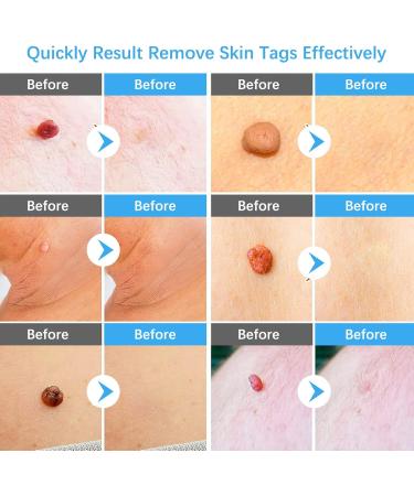 2-IN-1 Micro Skin Tag Tool Kit Quick and Painless Solution for Medium to Large Skin Tags (2mm-7mm) Complete Skin Tag Tool Kit for Fast Results - Buy Online on GoSupps.com