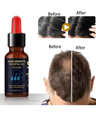 Nourishing Hair Growth Oil Serum for All Hair Types - Stimulates Scalp, Thickens and Promotes Density - 1pcs - Buy Online on GoSupps.com