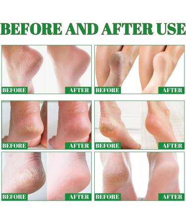 COALHO Heel Repair & Hydration Cream Rapid Crack Repair Foot Cream Anticracking Moisturizing Foot and Hand Cream Provides Comfortable Care 3 pieces - Buy Online on GoSupps.com