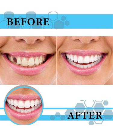 70PCS Temporary Tooth Crown Repair Kit - Dental Replacement Caps for Front Teeth - Oral Care Resin Crowns for False Tooth - Dental Repair Kit Included - Buy Online on GoSupps.com