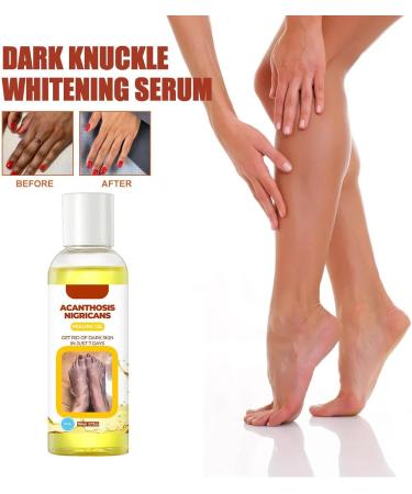  JPSDOWS Extra Yellow Peeling Oil Extra Strong Natural Spots Whiten for Dark Skin Whiten Yellow Peeling Oil for Exfoliates Improves Dullness Hyperpigmentation Evens Out - Buy Online on GoSupps.com