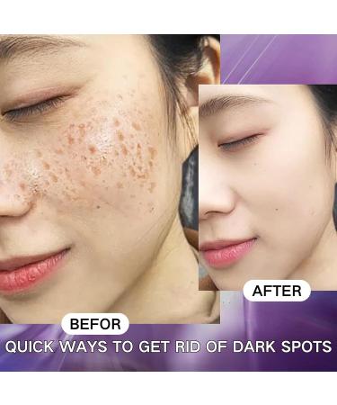 Dark Spot Remover for Face Spot Cream Dark Spot Corrector Skin Lightening Cream Pigmentation Removal Cream Dark Spot Correcting Glow Serum for Melasma Freckle Sun Spot Remover Blemish Reduction - Buy Online on GoSupps.com