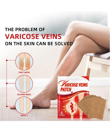 Spider Vein Plaster 30ct | Varicose Vein & Phlebitis Care | Leg Vein Removal Treatment - Buy Online on GoSupps.com