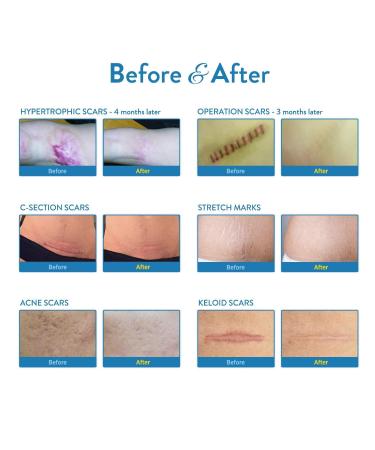 Aroamas Silicone Scar Removal Sheets 4 pcs White Professional, Drug-Free Solution for Burn, Keloid, Acne, Surgery Scars Soft Adhesive Fabric Strips, 2 Month Supply - Buy Online on GoSupps.com