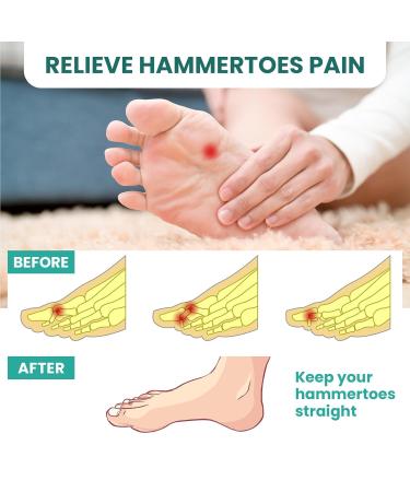 Welnove Hammer Toe Corrector & Straightener - 8 Pcs Toe Support Pads for Realigning Bent Curled & Hammer Toes - Optimal Comfort & Alignment - Buy Online on GoSupps.com