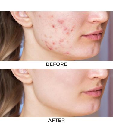 Day & Night Cystic Spot Treatment Kit by Ayadara - Salicylic Acid Cream & Overnight Sulfur Treatment for Hormonal & Severe Acne - Buy Online on GoSupps.com