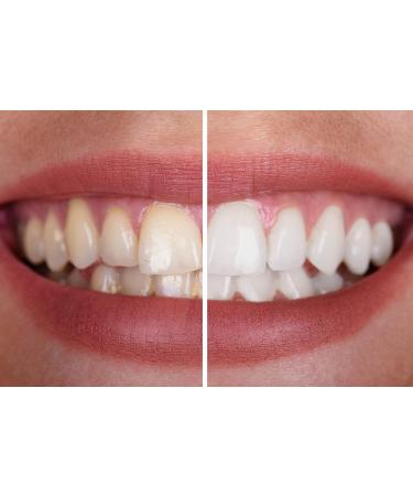 IllumOnate Teeth Whitening Strips - Non Slip, Enamel Safe - Removes Coffee, Wine, and Smoking Stains - Buy Online on GoSupps.com