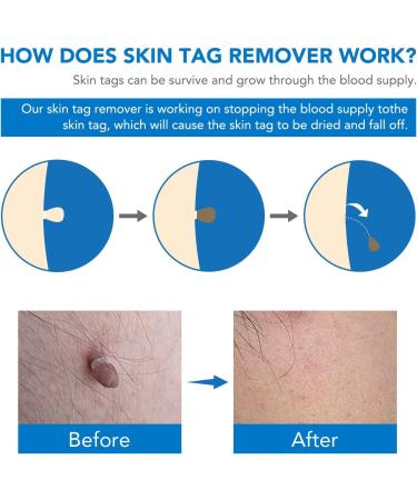 Skin Tag & Mole Remover Kit - Safe & Painless Removal for Small to Large Skin Tags (2mm-8mm) - Buy Online on GoSupps.com