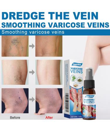 yiyoujie Leg Care Spray Gentle Relief Leg Discomfort Varicose Veins Repair Daily Care - Buy Online on GoSupps.com