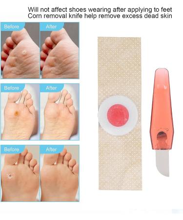 18 Patch Foot Corn Remover Pads | Callus Removal Stickers & Knife Set - Buy Online on GoSupps.com